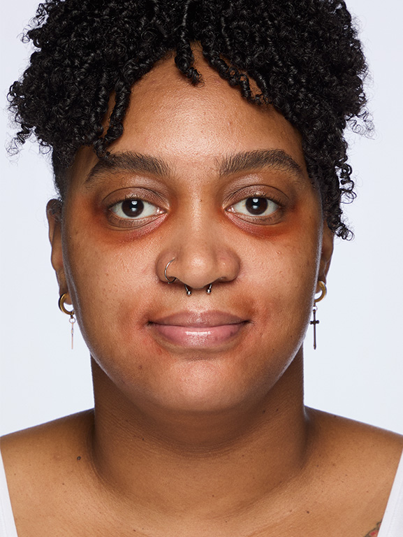 Week 12 of woman afterapplication of Mircale Set.